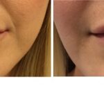 Uneven Lips Before and After