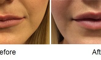 Uneven Lips Before and After