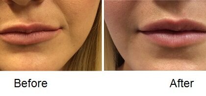 Uneven Lips Before and After