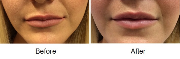 Uneven Lips Before and After