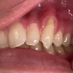 Which Are Eye Teeth?