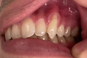 Which Are Eye Teeth?