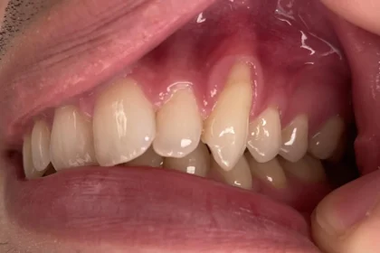 Which Are Eye Teeth?